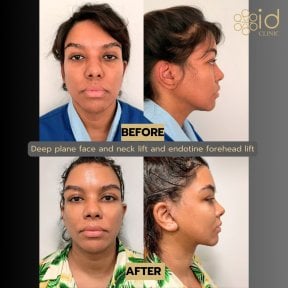 before-after photo deep-plane-facelift
