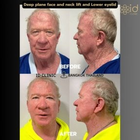 before-after photo deep-plane-facelift