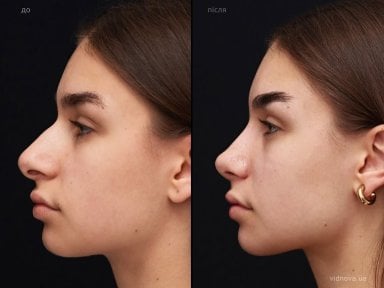 before-after photo rhinoplasty-nose-job