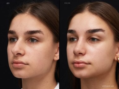 before-after photo rhinoplasty-nose-job
