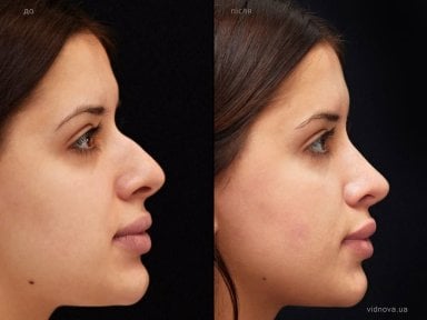 before-after photo rhinoplasty-nose-job