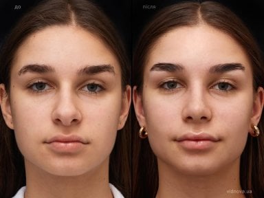 before-after photo rhinoplasty-nose-job