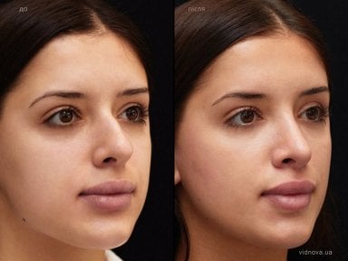 before-after photo rhinoplasty-nose-job