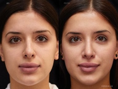 before-after photo rhinoplasty-nose-job