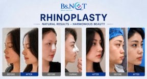 Resultados de rinoplastia antes y después en clínica Bs.NgT, remodelación nasal natural