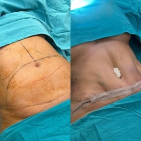 before-after photo liposuction