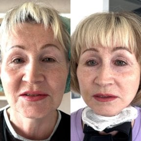 before-after photo deep-plane-facelift