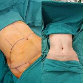 before-after photo abdominoplasty