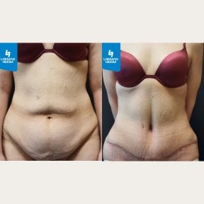 before-after photo abdominoplasty