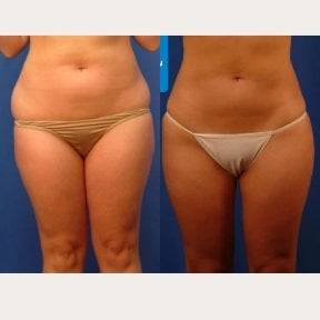 before-after photo liposuction