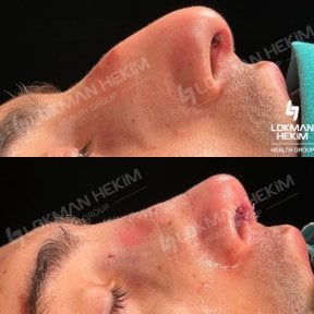 before-after photo tip-rhinoplasty
