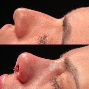 before-after photo tip-rhinoplasty