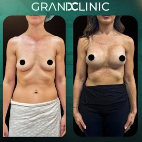 before-after photo mastopexy-breast-lift-contour-plastics
