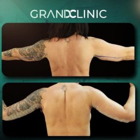before-after photo arms-plastics-brachioplasty
