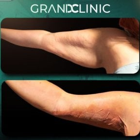 before-after photo arms-plastics-brachioplasty