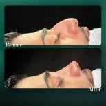 Before and after open rhinoplasty results at Grand Clinic, improved nose profile visible