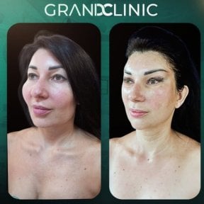 before-after photo facial-feminization-surgery