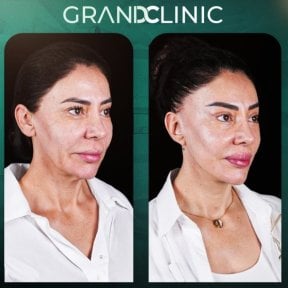 before-after photo facial-feminization-surgery
