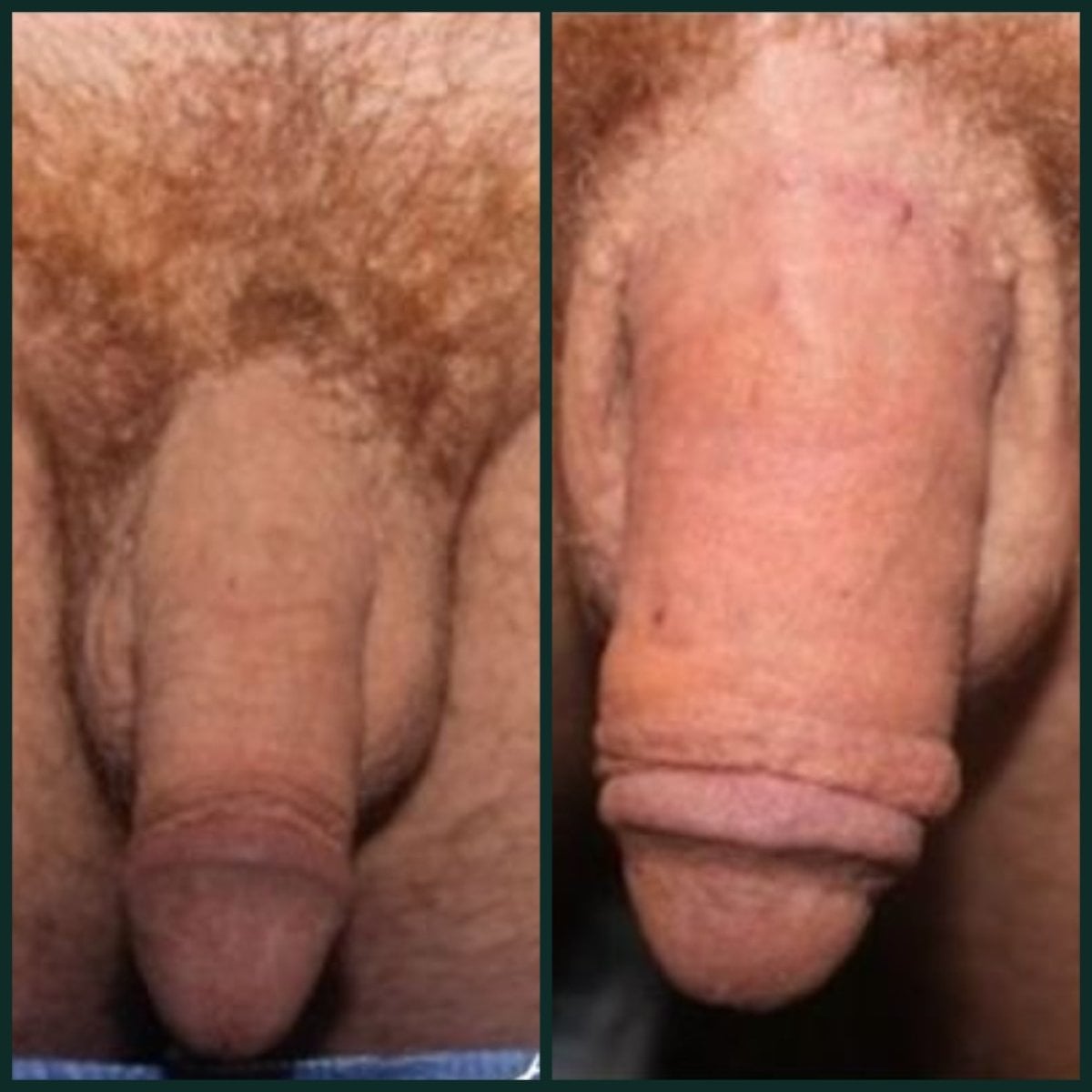 Resultados antes y después de relleno de pene en Grand Clinic – aumento visible de grosor