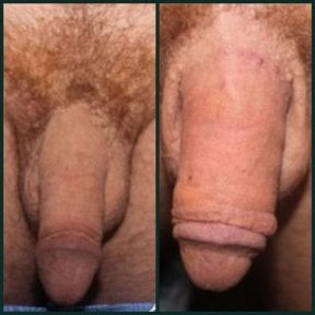 before-after photo penis-filler