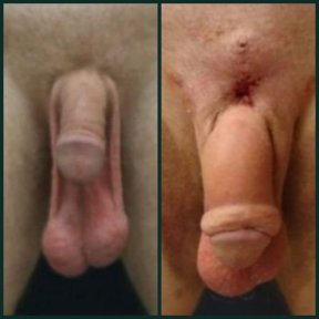 before-after photo penis-filler