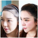 نتيجة زراعة الشعر قبل وبعد في Dr.Orn Clinic : Medical Hair، خط شعر محسّن