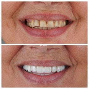 before-after photo dental-crown-installation