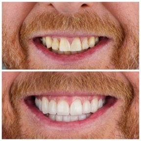 before-after photo dental-crown-installation