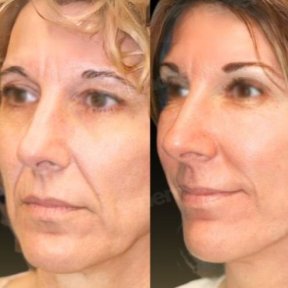 before-after photo mini-facelift