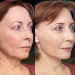 before-after photo mini-facelift