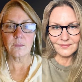 before-after photo mini-facelift