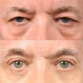 before-after photo upper-eyelid-surgery