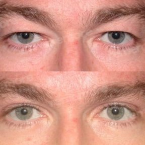 before-after photo upper-eyelid-surgery
