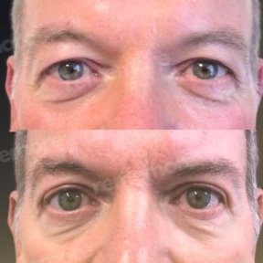 before-after photo upper-eyelid-surgery