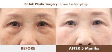 before-after photo podtazka-kozi-lica-fejslift
