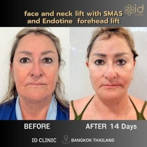 before-after photo deep-plane-facelift
