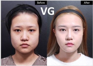 Before and after jaw reduction surgery results at VG Plastic Surgery – slimmer facial contour