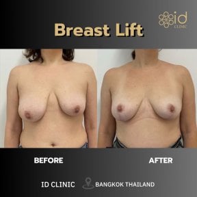 Vorher-nachher-Ergebnis Bruststraffung bei ID Clinic Bangkok, verbesserte Brustform