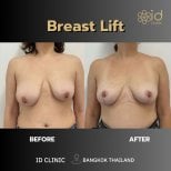 Vorher-nachher-Ergebnis Bruststraffung bei ID Clinic Bangkok, verbesserte Brustform