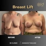 Vorher-nachher-Ergebnisse Bruststraffung bei ID Clinic Bangkok – verbesserte Brustform