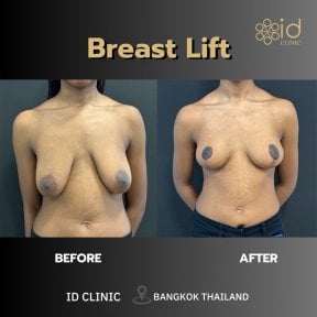 Vorher-nachher-Ergebnis Bruststraffung bei ID Clinic Bangkok – verbesserte Kontur