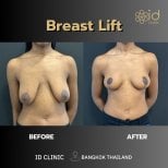 Vorher-nachher-Ergebnis Bruststraffung bei ID Clinic Bangkok – verbesserte Kontur