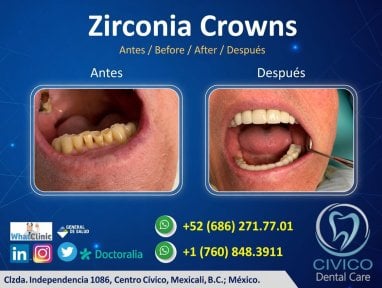 نتيجة قبل وبعد تيجان الزركونيا في CIVICO DENTAL CARE MEXICALI، استعادة الابتسامة