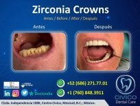نتيجة قبل وبعد تيجان الزركونيا في CIVICO DENTAL CARE MEXICALI، استعادة الابتسامة