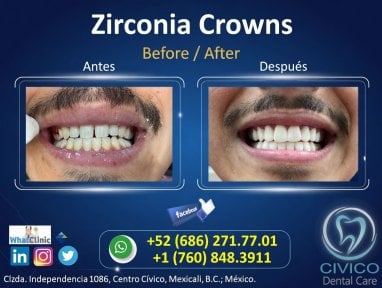 نتيجة قبل وبعد تركيب تيجان الزركونيا في CIVICO DENTAL CARE MEXICALI، تحسين الابتسامة