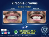 نتيجة قبل وبعد تركيب تيجان الزركونيا في CIVICO DENTAL CARE MEXICALI، تحسين الابتسامة