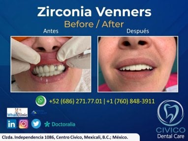 نتائج قبل وبعد عدسات الزركونيا في CIVICO DENTAL CARE MEXICALI، تحول الابتسامة