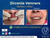نتائج قبل وبعد عدسات الزركونيا في CIVICO DENTAL CARE MEXICALI، تحول الابتسامة