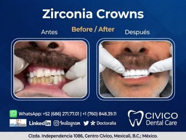 نتيجة قبل وبعد تيجان الزركونيا في CIVICO DENTAL CARE MEXICALI، استعادة الابتسامة