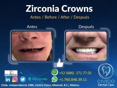 نتيجة قبل وبعد تيجان الزركونيا في CIVICO DENTAL CARE MEXICALI، استعادة الابتسامة